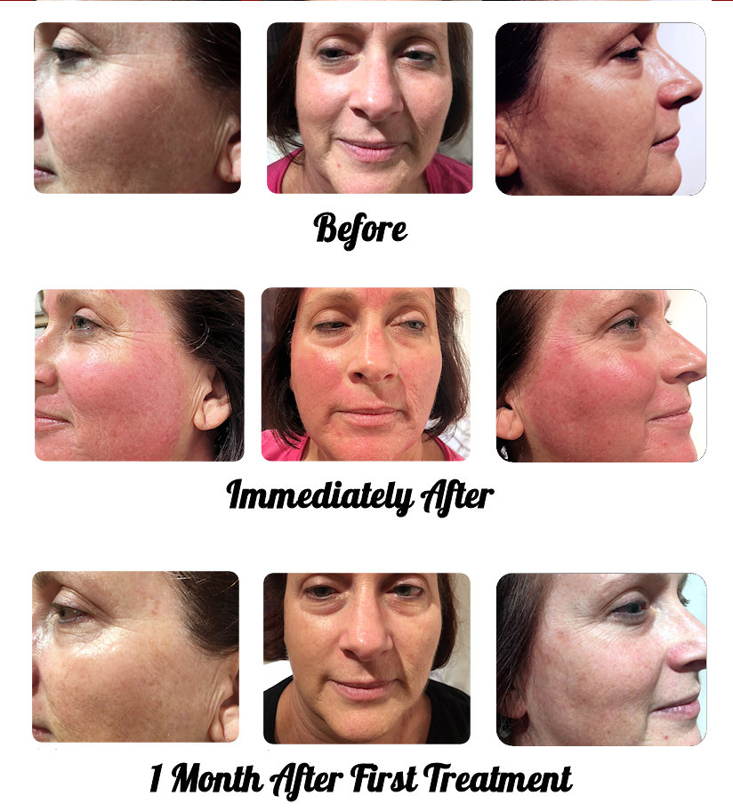 Micro Needling Treatment: Great results are visible after on after only 1 month