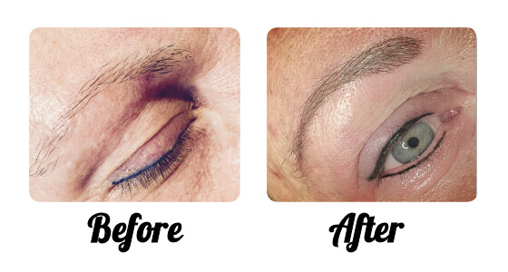 Micro-Blading: This technique has given the appearance of a realistic eyebrow that is both fuller and more even.